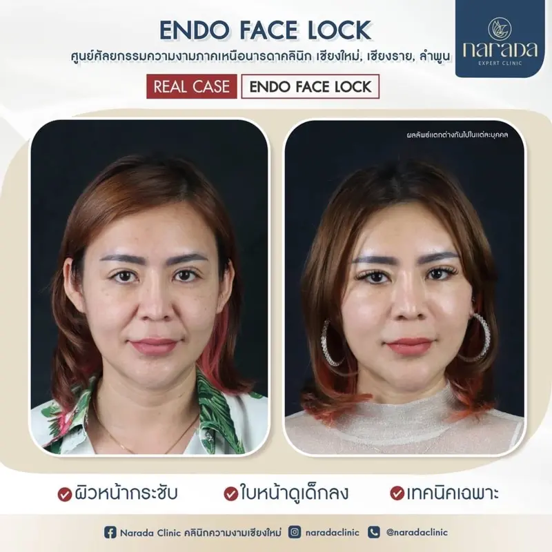 🎊 เทคนิคพิเศษผ่าตัดดึงหน้า ENDO FACE LOCK ที่นารดาคลินิก🎊🎊