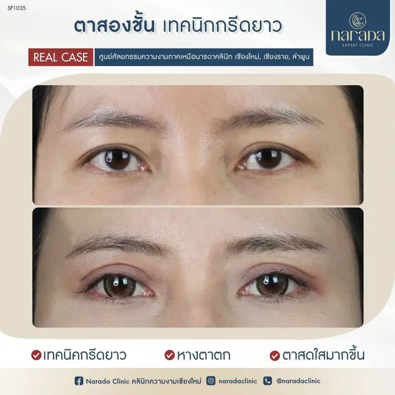 😁รอช้าอยู่ทำไม เปิดดวงตาให้สดใส เหมือนเปิดใจให้พองโต😁