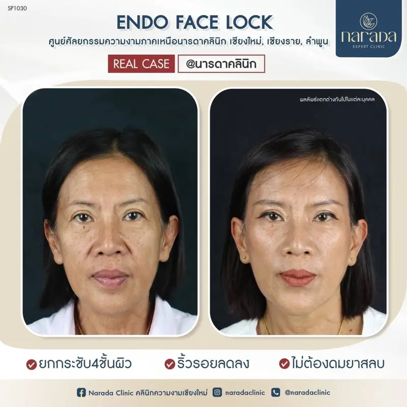 💁‍♀️ผ่าตัดดึงหน้า พร้อมเทคนิค พิเศษของ นารดาคลินิ💁‍♀️