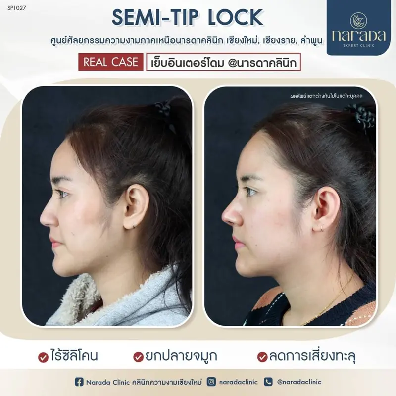 ยกปลายจมูกด้วยเทคนิค ไร้ซิลิโคน ลดการเสี่ยงทะลุ👃🏻 เทคนิค SEMI-TIP LOCK ล็อกปลายสวย 👃🏻