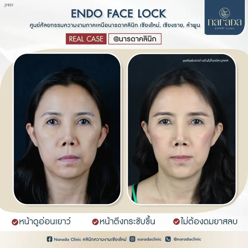 👩‍🔬เปลี่ยนร่องน้ำหมาก ให้ดูตึง💁‍♀️