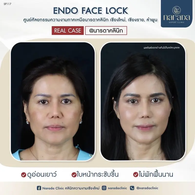 😄สวย ลดอายุ ผิวกระชับ ดูอ่อนวัย ไม่พักฟื้นนาน😁 ด้วยเทคนิค ENDO FACE LOCK