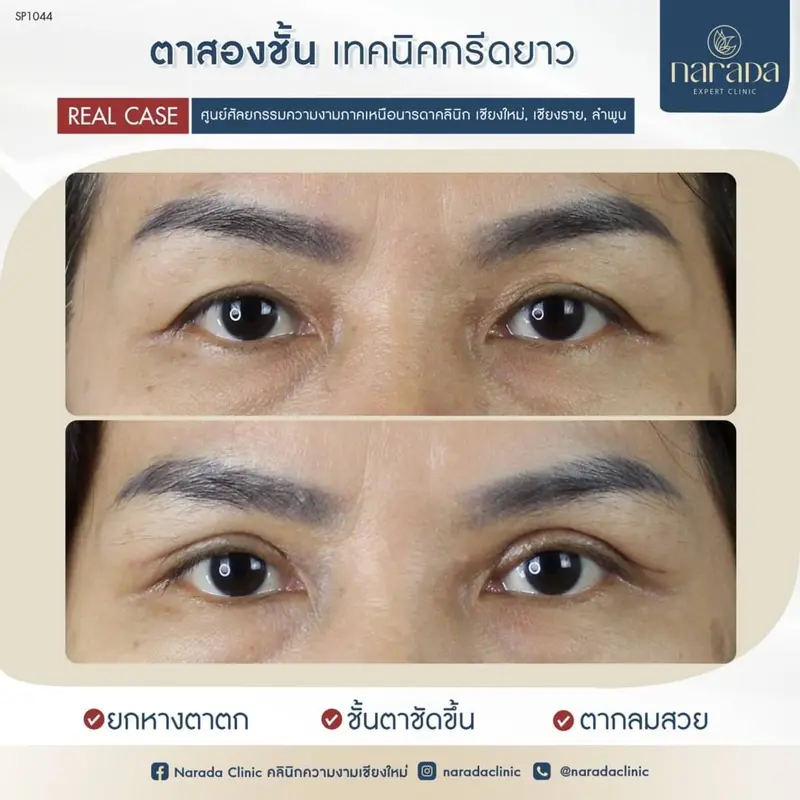 💁‍♀️บอกลาตาบวมที่อยู่มานาน เพิ่มลูกเล่นให้ดวงตา💁ด้วยเทคนิคกรีดยาว ทำตาสองชั้น