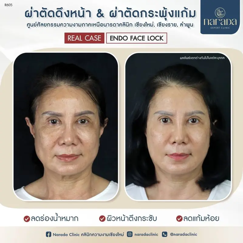 หลังจากบอกลาไขมันที่แก้มแล้ว ยังบอกลาผิวหนังที่หย่อนคล้อย