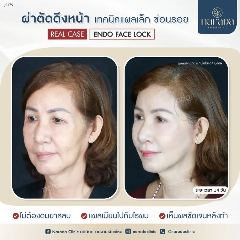 ยิ่งอายุมากขึ้น ผิวหน้าก็เริ่มหย่อนคล้อยตามมาจากที่เคยโดยเรียกพี่ก็ต้องเรียกป้า