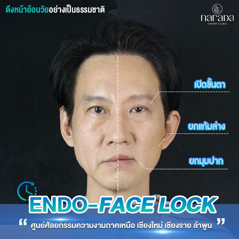 😁ตาบวม แก้มหย่อนคล้อย ผิวหน้าไม่กระชับ