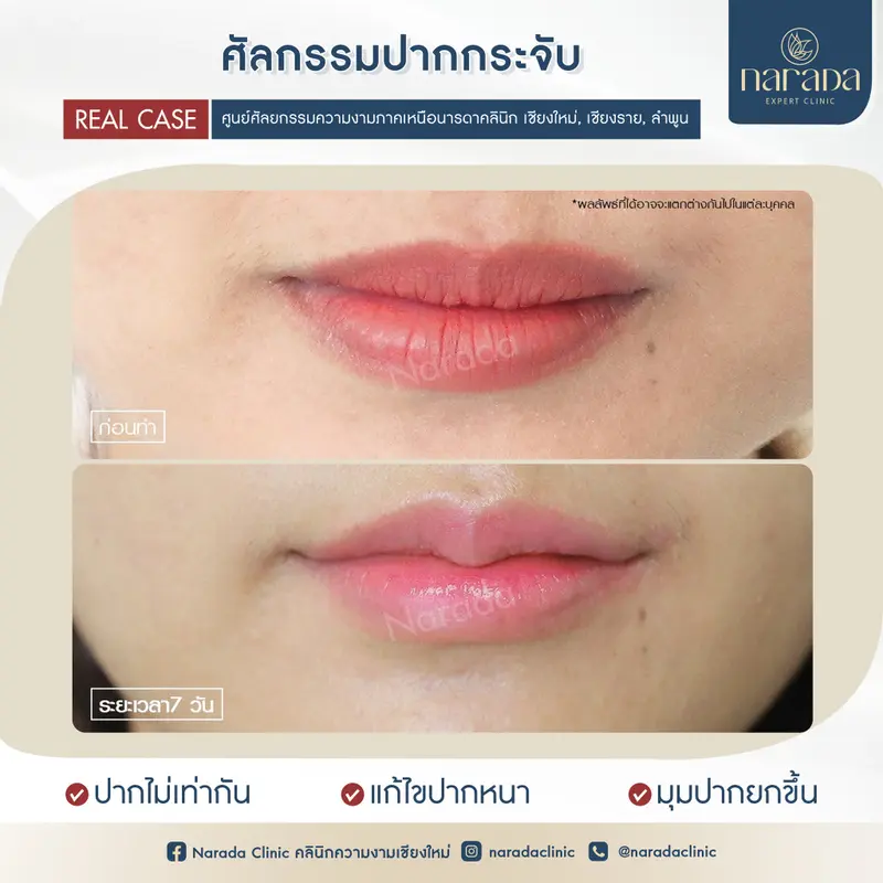 ✨✨ปากกระจับ เพิ่มรอยยิ้มที่มีเสน่ห์ อย่างเป็นธรรมชาติ✨✨