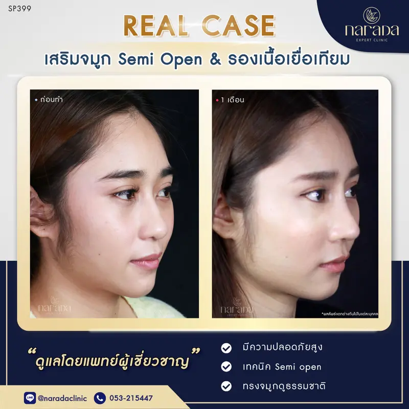🌈✨เพิ่มมิติบนใบหน้า ยืดปลายจมูก ปรับทรงจมูกสโลปสวย ที่ นารดาคลินิก🌈✨