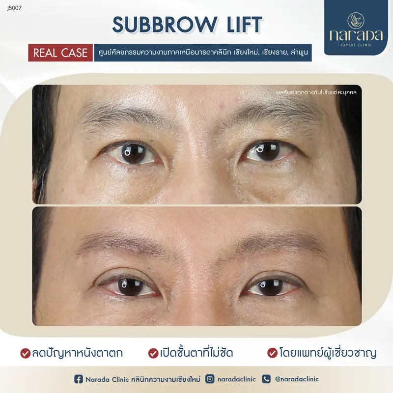 🎀Subbrow Lift ช่วยแก้ไขปัญหาคิ้วตก🎀 หนังตาหย่อนคล้อย ให้ดวงตากลับมาดูสดใส และอ่อนเยาว์ลง