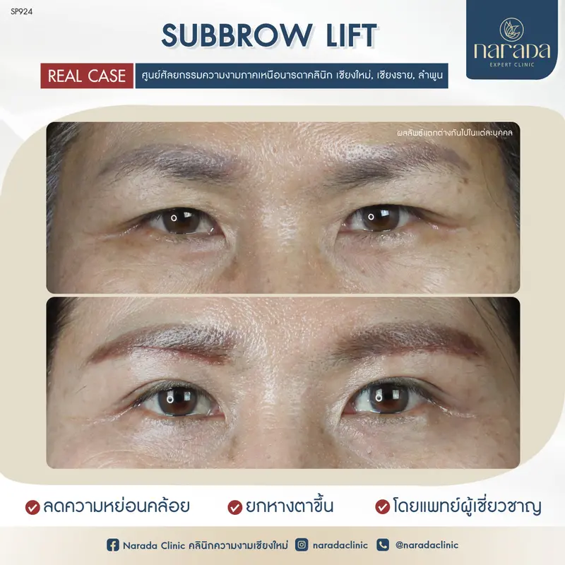 🏥🎀บอกลาปัญหาหนังตาหย่อนคล้อย คิ้วตก🏥🎀