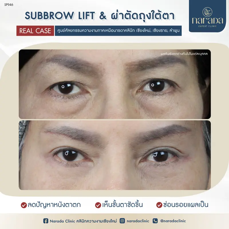 👑🥇เบื่อไหมเมื่ออายุเพิ่มขึ้น ดวงตาก็ดูไม่สดใส👑🥇