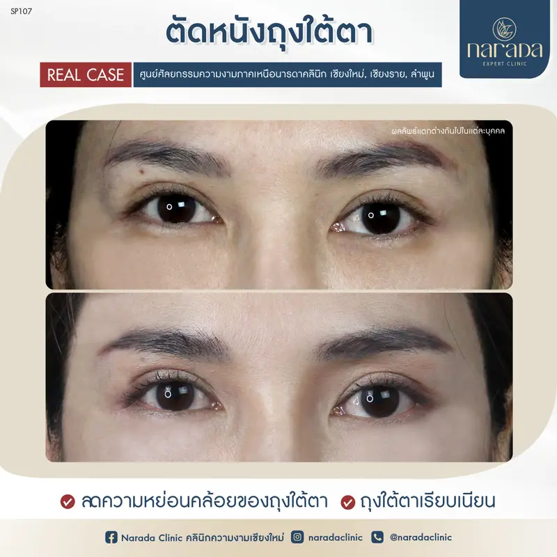 🎀เปลี่ยนดวงตาที่ดูไม่สดใส มีถุงใต้ตาและรอยย่นใต้ดวงตา🎀