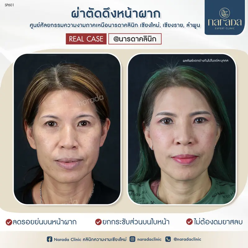 👑หมดปัญหารอยย่นบนหน้าผาก ผิวหนังหย่อนคล้อย👑