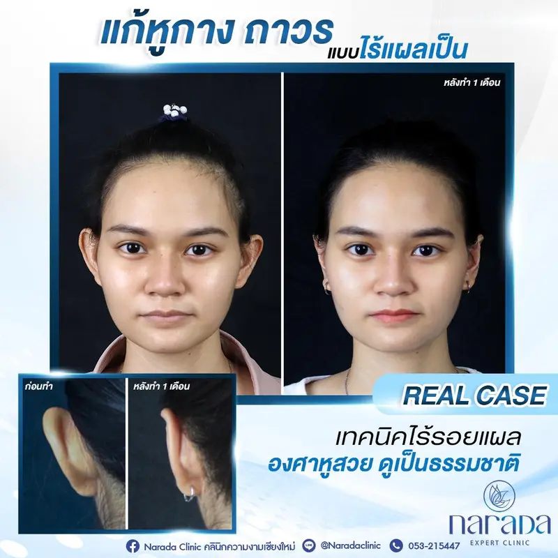แก้ไขหูกาง เทคนิคไร้รอยแผล องศาหูสวย ดูเป็นธรรมชาติ ที่ นารดาคลินิก