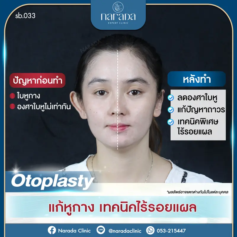 Otoplasty แก้ไขหูกางถาวรไร้รอยแผลเป็น
