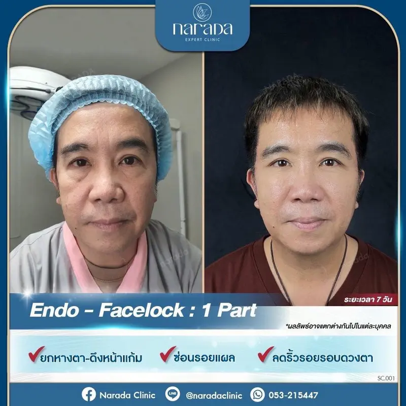 เมื่อผิวหนังเริ่มหย่อนคล้อย ริ้วรอยและร่องลึก ต่างๆบนใบหน้าเริ่มชัดขึ้น แก้ไขได้ที่นารดาคลินิก