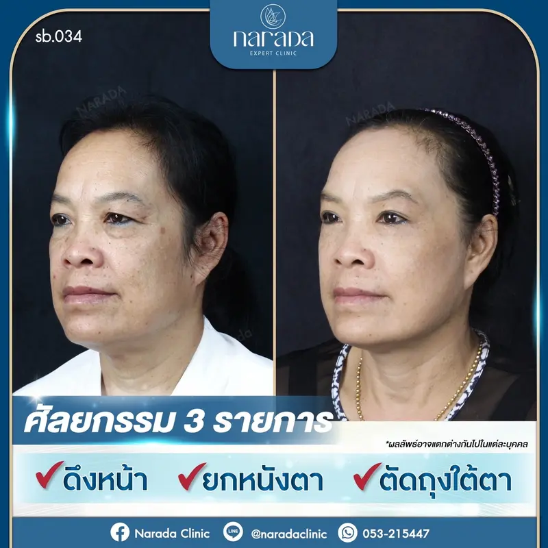 เปลี่ยนใบหน้าที่หย่อนคล้อย ให้กลับมาอ่อนเยาว์ ลงอีกครั้งที่ นารดาคลินิก