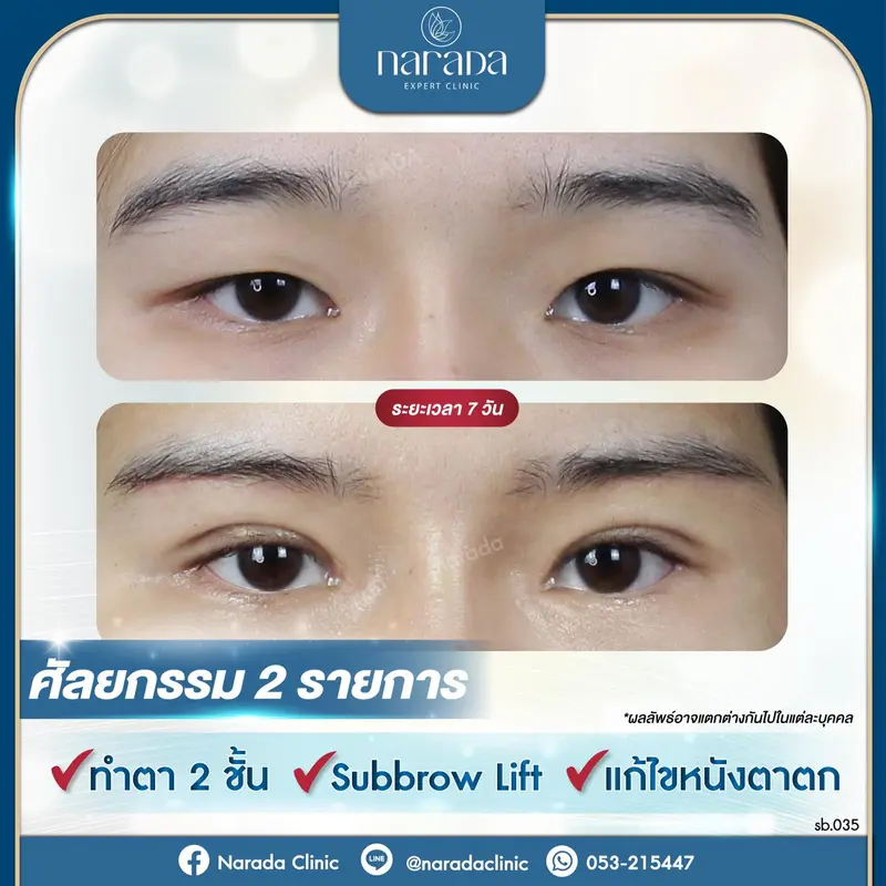 เปลี่ยนดวงตาสาวหมวยให้กลับมาดูสวยหวาน 