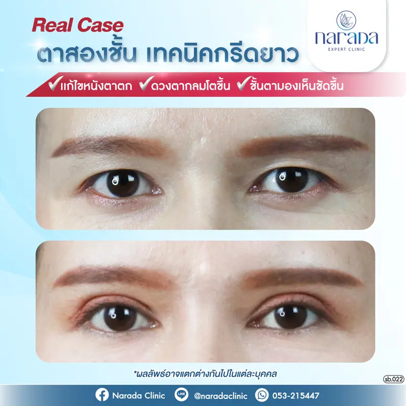 เมื่อชั้นตาหลบใน ทำให้มองเห็นชั้นตาไม่ชัด