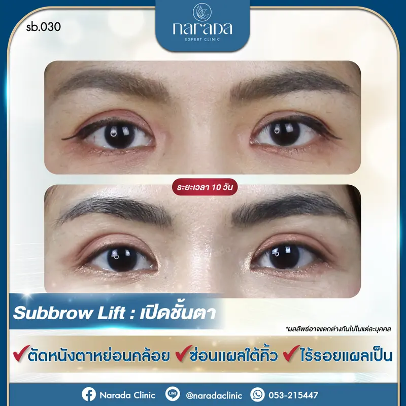 Subbrow Lift : เปิดชั้นตา👁️👁️