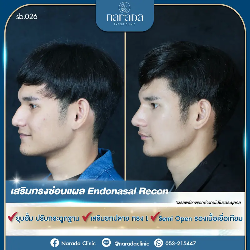 เสริมจมูกทรงซ่อนแผล Endonasal Recon มาเปลี่ยนทรงจมูกให้ดูมีมิติ
