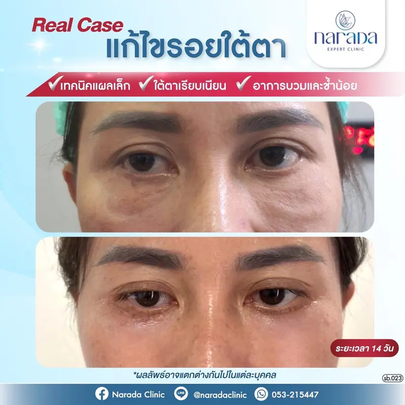 เมื่อมีปัญหารอยใต้ตาไม่เรียบเนียน ที่เกิดจากถุงไขมัน ใต้ตา ริ้วรอย หรือซิลิโคนเหลวต่างๆ 