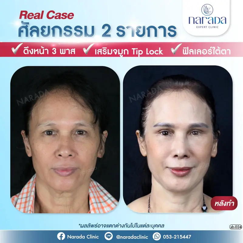 💁🏻‍♀️เปลี่ยใบหน้าที่ดูไม่สดใส ให้กลับมาอ่อนเยาว์💁🏻‍♀️