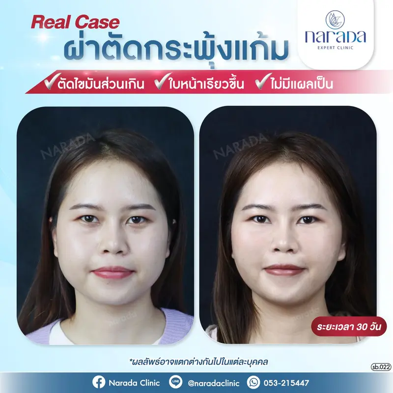 หมดปัญหาไขมันกระพุ้งแก้มเยอะ ทำให้ใบหน้าไม่เรียว