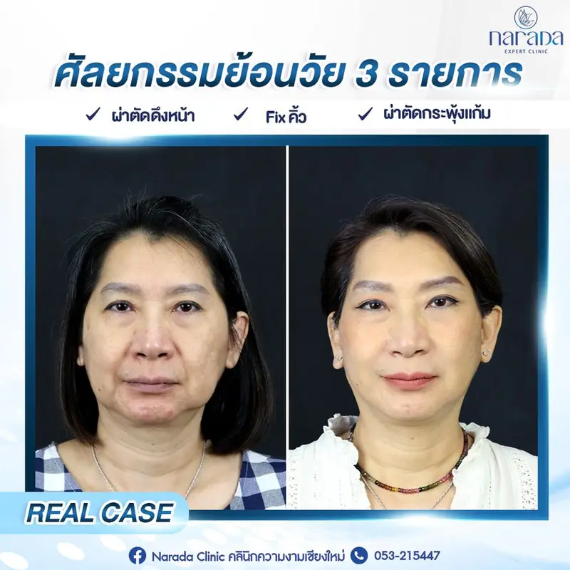 Real Case ศัลยกรรมย้อนวัย 3 รายการ