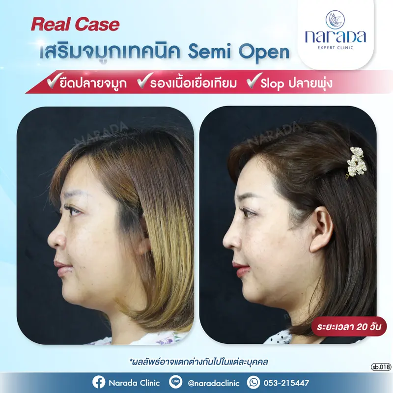 มาปรับทรงจมูกให้ใบหน้าดูสวย หวานขึ้น