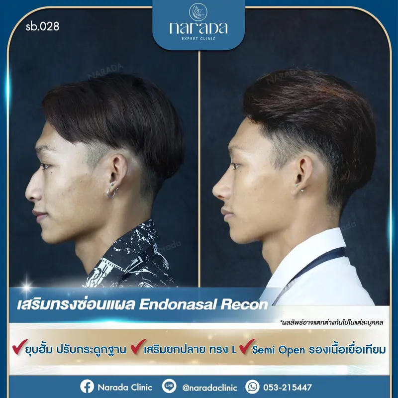 ยุบฮั้ม ปรับฐานกระดูก เสริมจมูกยกปลายทรง L เทคนิคซ่อนแผล