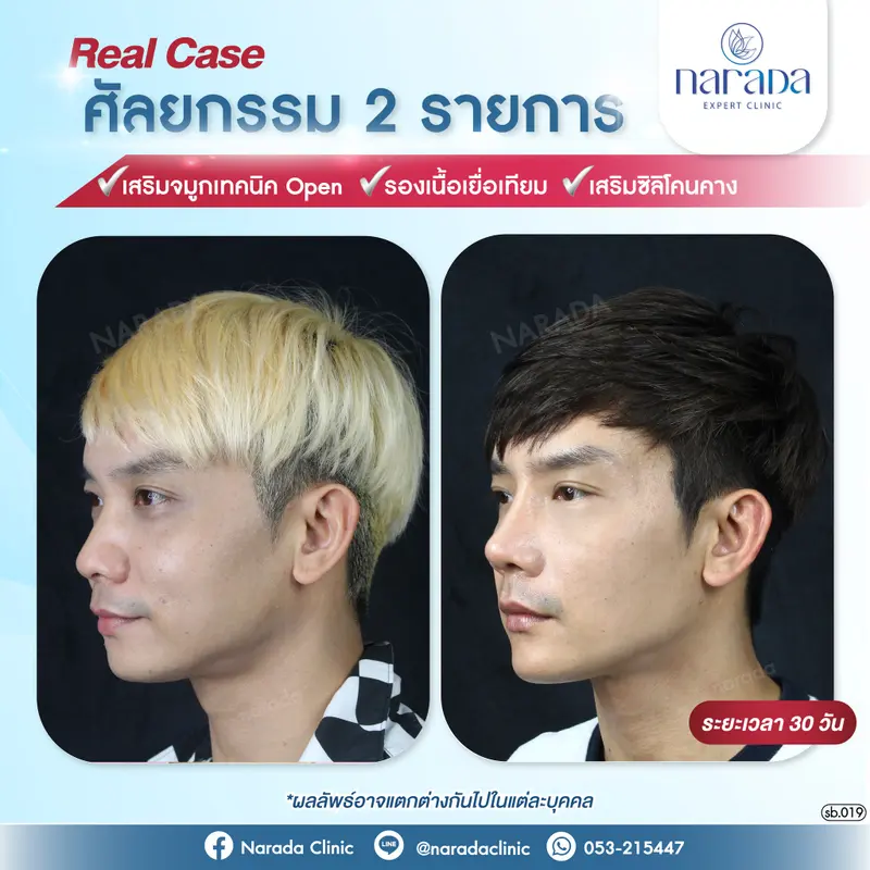 เมื่อจมูกและคางดูไม่มีมิติบนใบหน้า ทำให้ไม่ได้สัดส่วน