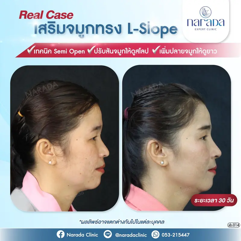 ปรับทรงจมูกให้ดูคมชัด เสริมโหวงเฮ้งให้ดูดี