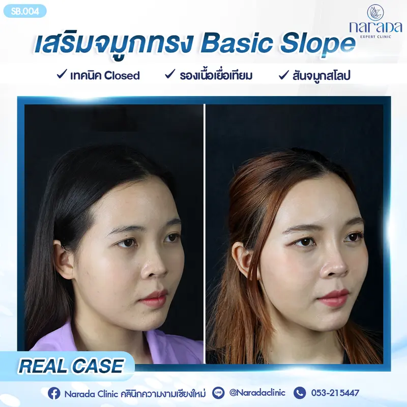 เปลี่ยนทรงจมูกให้สโลปสวย เข้ากับใบหน้า เสริมจมูกทรง Basic Slope+รองเนื้อเยื่อเทียม