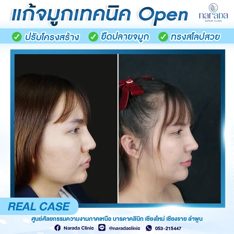 🏆รีวิวแก้จมูกใหม่ ให้ทรงดูสวยหวานเข้ากับ🏆