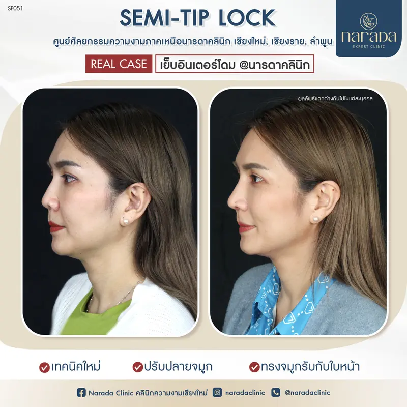 🎀🎈มาเพิ่มความมั่นใจให้กับรูปทรงจมูก ให้ดูสโลป🎀🎈