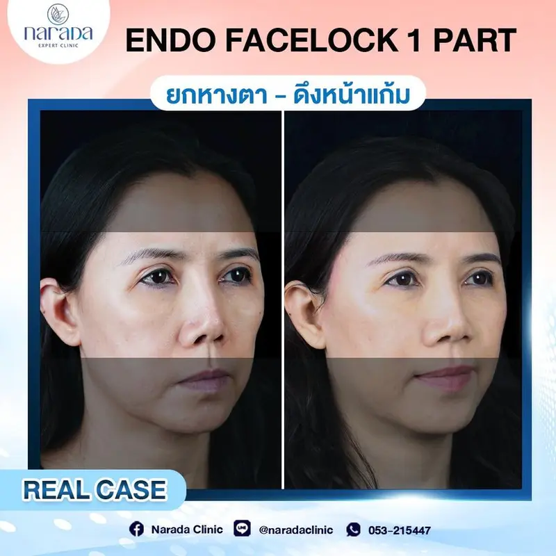 🌸มาเปลี่ยนผิวหน้าที่หย่อนคล้อย ให้กลับมา สวย ตึง ขึ้น ที่ นารดาคลินิก