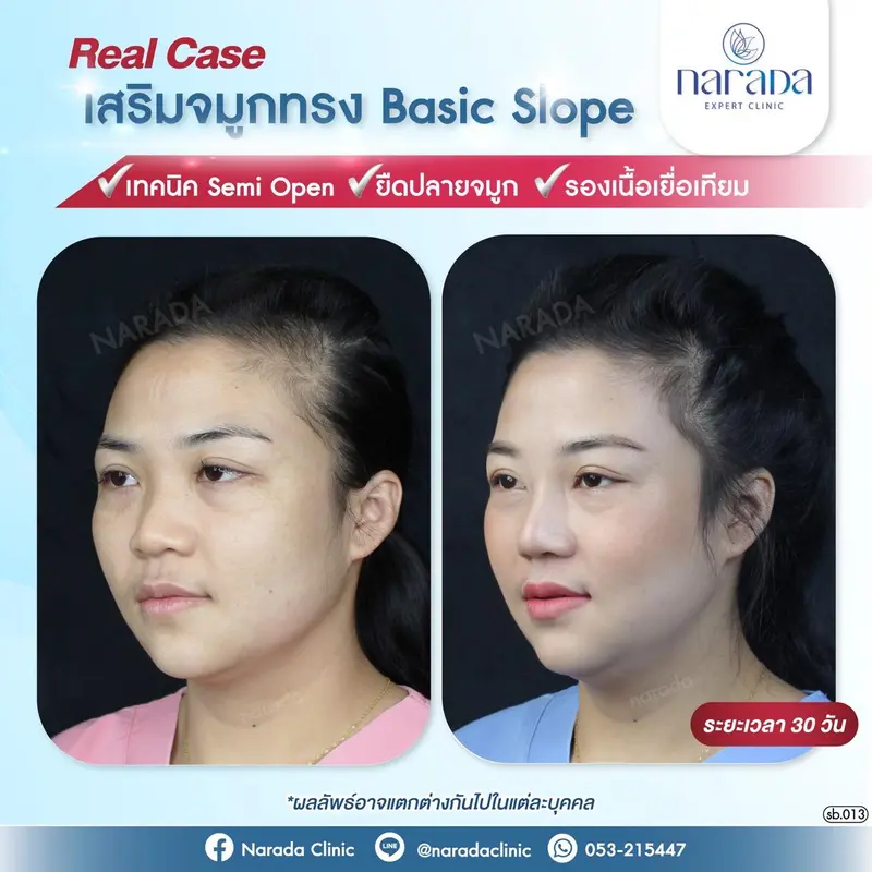 เสริมจมูก ยกปลาย ให้ใบหน้าดูมีมิติมากขึ้น