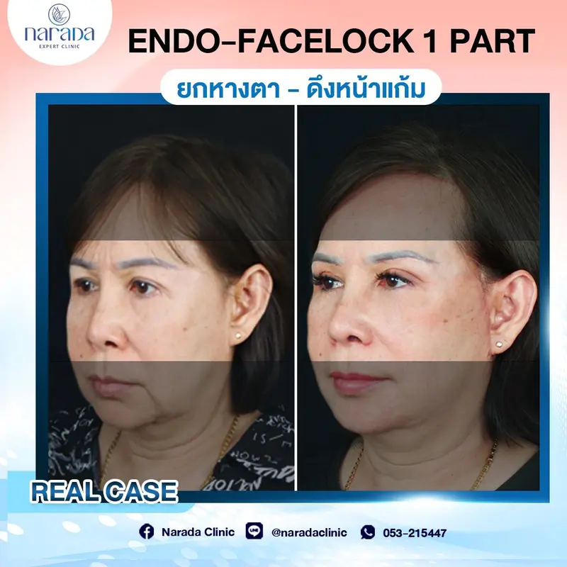 เปลี่ยนผิวหน้าย่อนคล้อย ให้เต่งตึงกระชับ 📣 กลับมาย้อนวัยอีกครั้ง ด้วยเทคนิค Endo-facelock