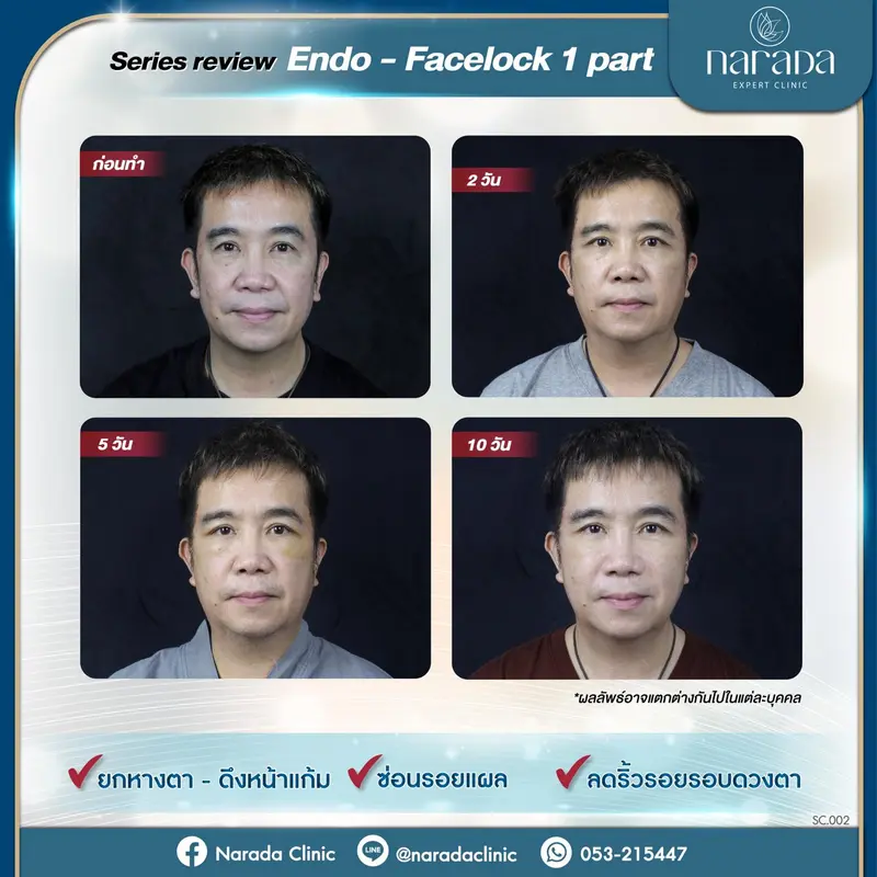 🙋🏻‍♂️Endo - Facelock 1 พาส ในแต่ละวันเป็นยังไงบ้าง🙋🏻‍♂️