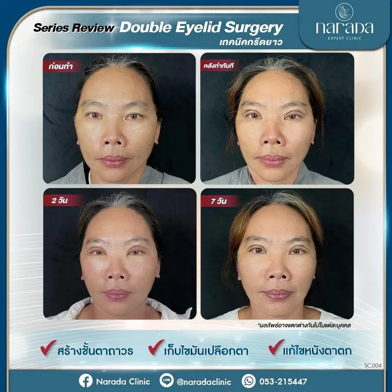 ✨Series Review อัพเดตความสวยของชั้นตา✨ หลังทำ Double Eyelid Surgery เทคนิคกรีดยาว