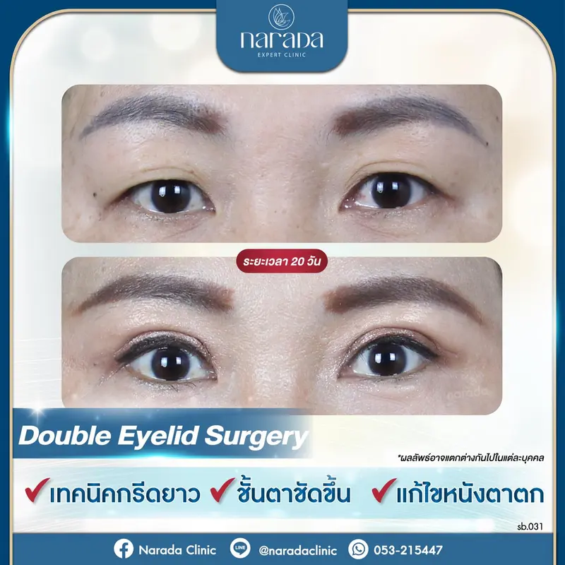 ✨เพิ่มเสน่ห์ให้ดวงตา ล็อคชั้นตาให้คมสวย✨ ด้วยการทำ ตาสองชั้นเทคนิคกรีดยาว ที่ นารดาคลินิก
