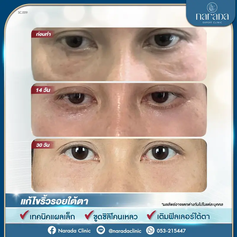 เมื่อใต้ตามีรอยเหี่ยวย่น มีริ้วรอยและร่องลึกต่างๆ จนทำให้ดวงตาดูมีอายุ