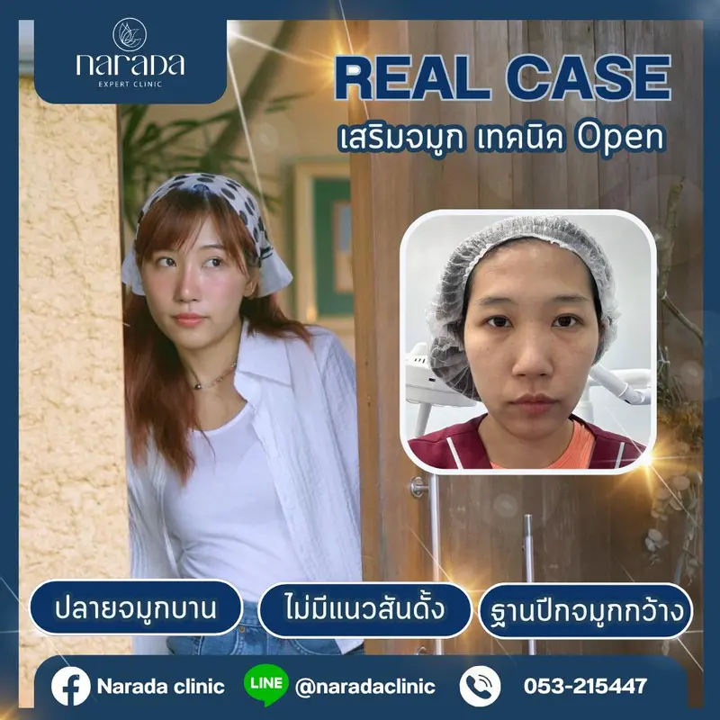 เพิ่มมิติให้กับใบหน้า หน้าหวานละมุนขึ้น อย่างเป็นธรรมชาติ ยืดปลายจมูก ปรับทรง