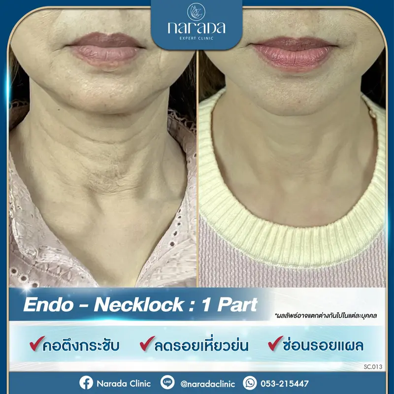 หมดปัญหา ริ้วรอยและความหย่อนคล้อย ของลำคอ แก้ไขได้ที่นารดาคลินิก