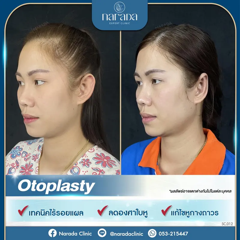 ปรับองศาใบหู ให้สวยรับเข้ากับ ใบหน้ามากขึ้น