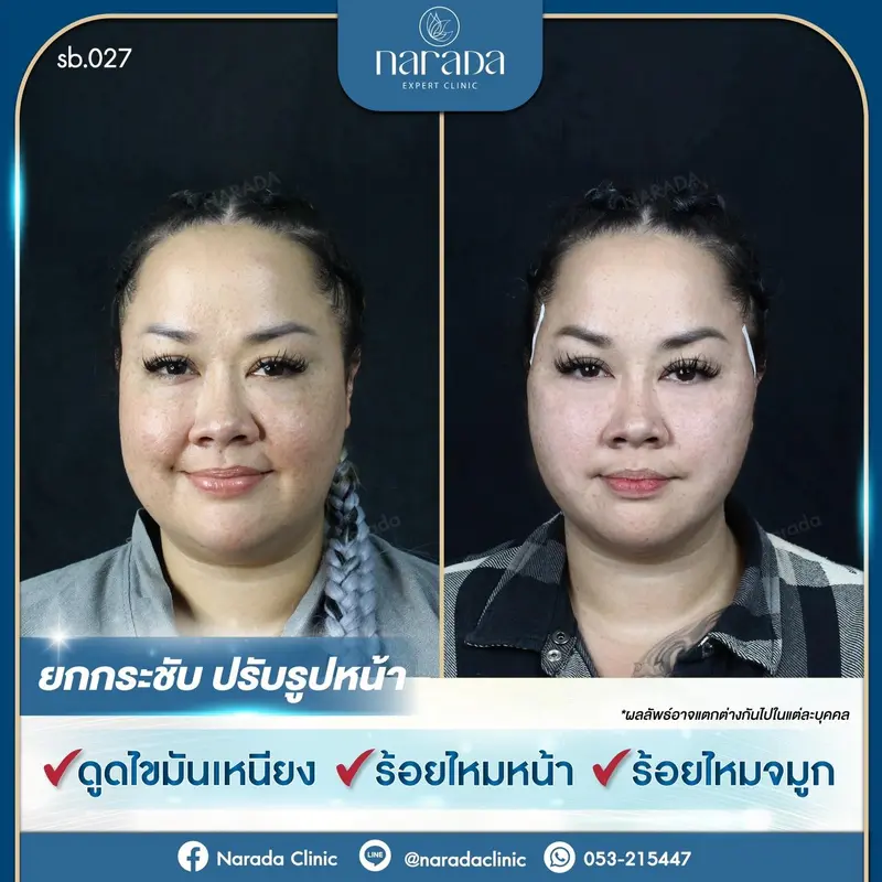 ให้ใบหน้ายกกระชับขึ้นบ้าง มาเพิ่มความมั่นใจ ให้ใบหน้าเรียวได้รูปขึ้น