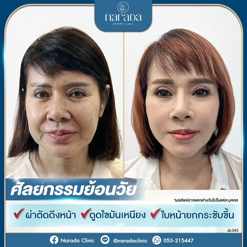 ✨ศัลยกรรมย้อนวัย คืนความสวยให้✨ กับใบหน้าอย่างสมวัย ที่นารดาคลินิก