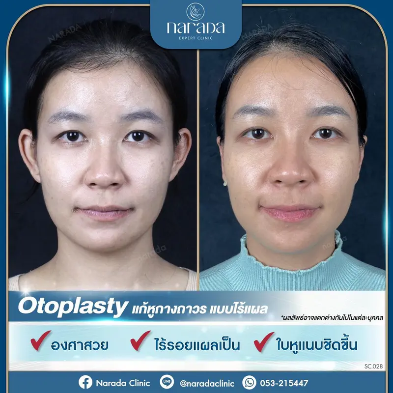 ✨ใบหูเรียวเล็กมั่นใจ มองมุมไหนก็สวยเป๊ะ✨ ใบหูใหญ่ไม่ใช่ปัญหา ปรึกษาเรา ที่นารดาคลินิก