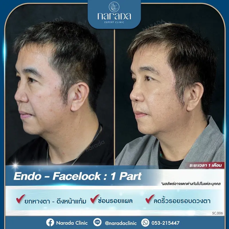 📣บอกลาความหย่อนคล้อย ริ้วรอย และร่องลึกต่างๆ